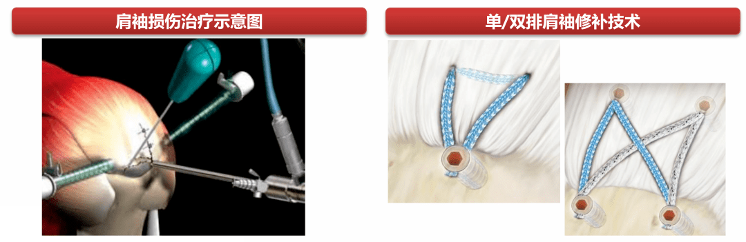 肩袖損傷治療 肩袖損傷治療