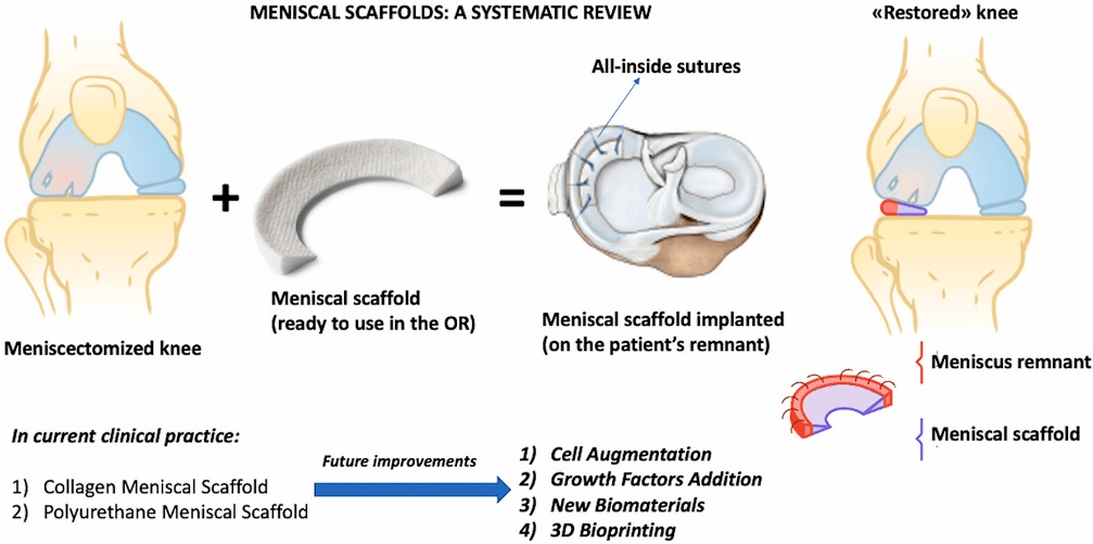 meniscal scaffolds meniscal scaffolds